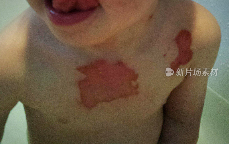 一个幼童胸部二级烧伤