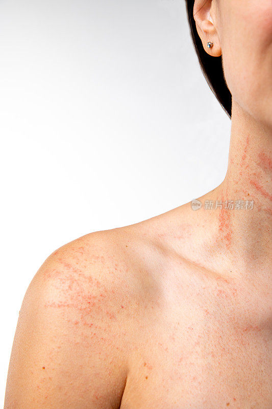 过敏症状颈部和手臂有红疹Itchinessfrom过敏原。
