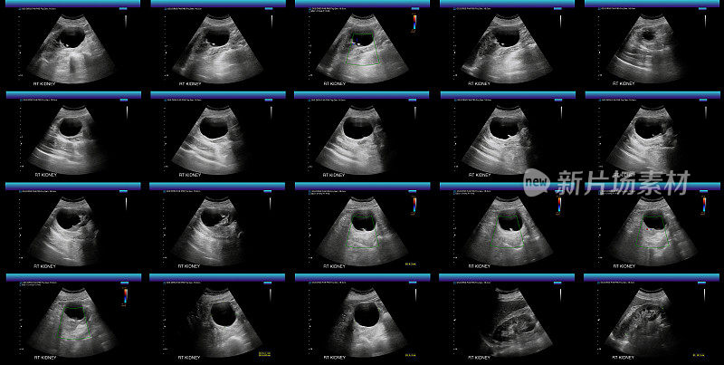 右肾超声序列