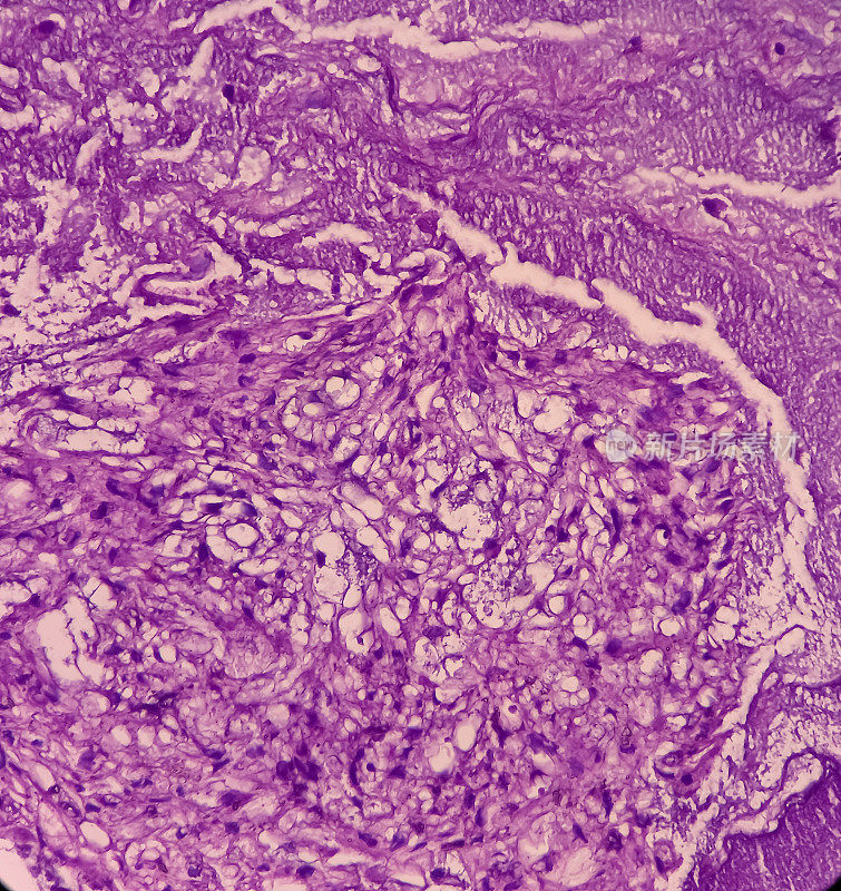 骶骨SOL，脊索瘤显微照片。显示软组织和骨性组织、恶性肿瘤、黏液样细胞间组织、发浆细胞、空泡状细胞质。