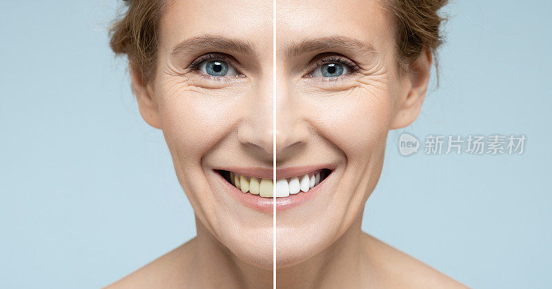 拼贴女性微笑前后牙齿美白。广告程序美白微笑