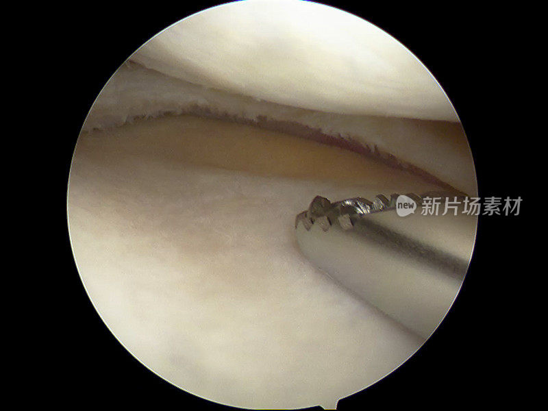 半月板撕裂部分切除术的关节镜观察