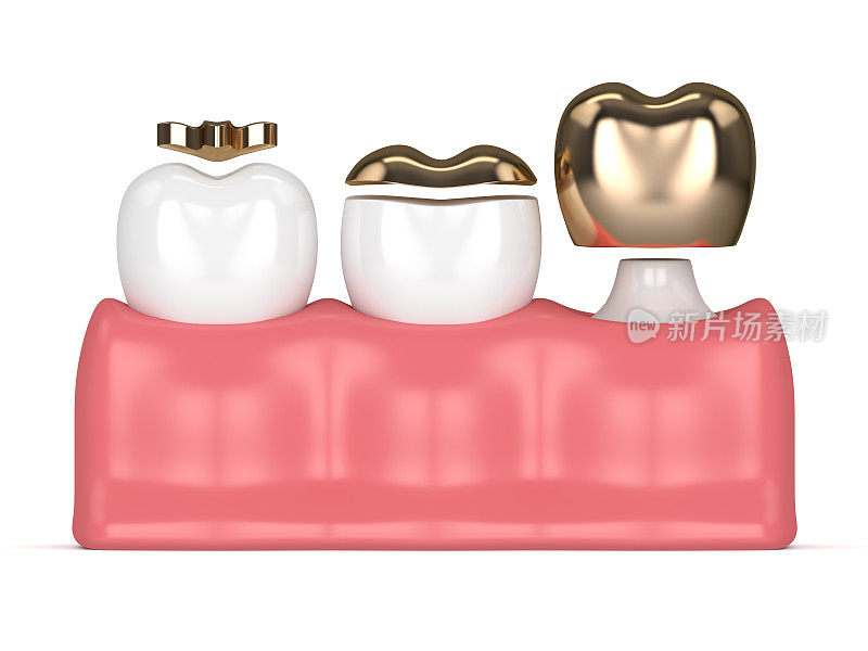 牙齿的黄金充填物的3d渲染