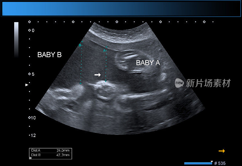 同卵双胞胎男孩产科超声