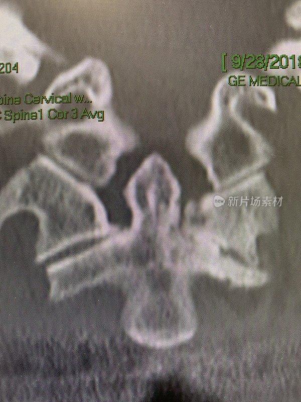 CT冠状面寰枢外侧肿块性骨关节炎