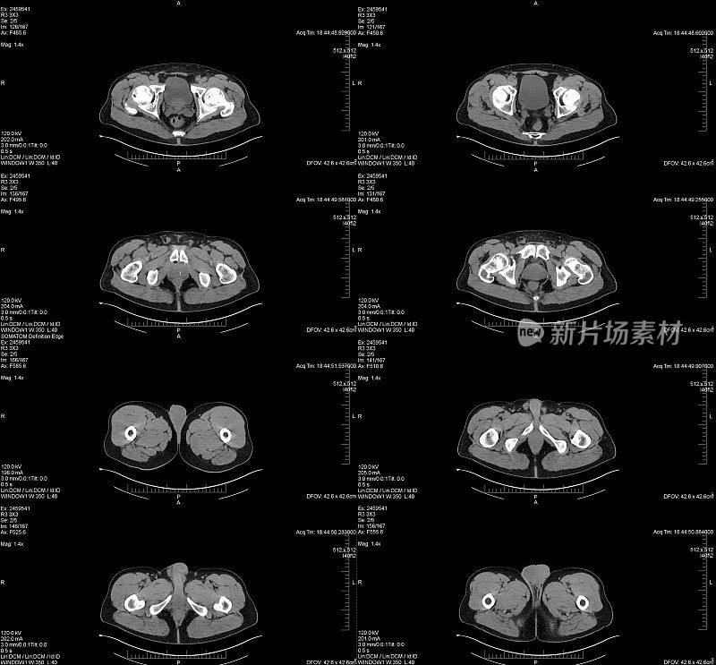 腹部骨盆Cat扫描顶部视图与注释