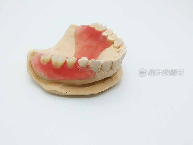 上颌骨部分假牙