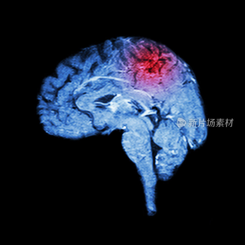 脑和中风的磁共振成像(MRI)