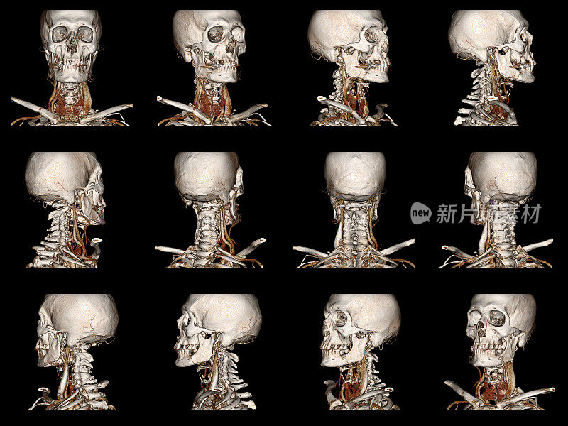 CT人类脖子