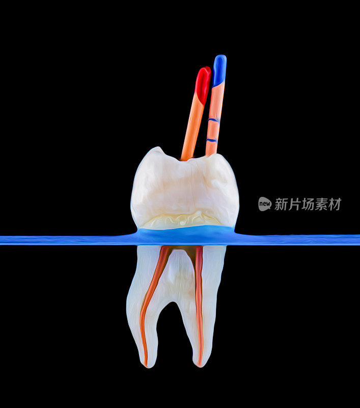根管治疗时的牙片宏观捕捉
