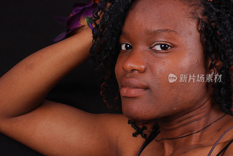黑女人有严重的痤疮和斑点