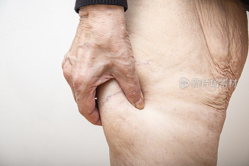 一位年长的女士抱着，拉着大量多余松弛的腿部皮肤，减肥后，做了胃绕道手术