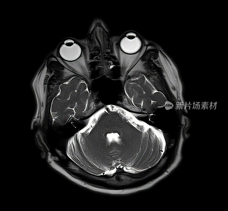 磁共振成像脑部扫描图像(MRI)