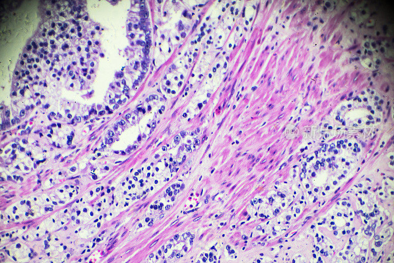 显微镜下前列腺癌活检