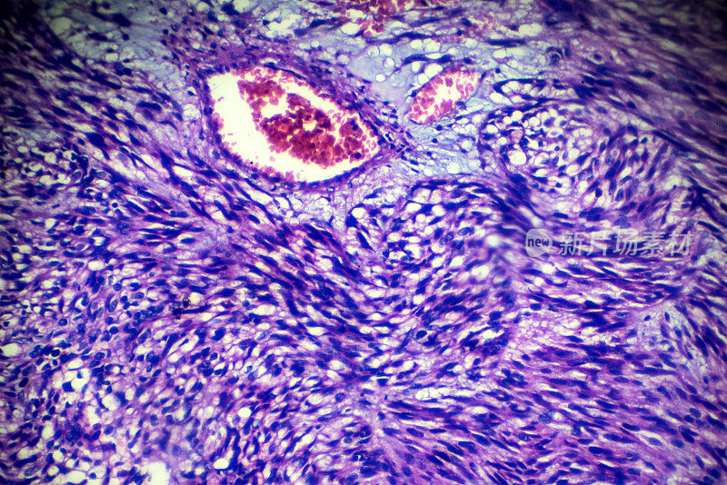 光镜下子宫平滑肌瘤活检标本
