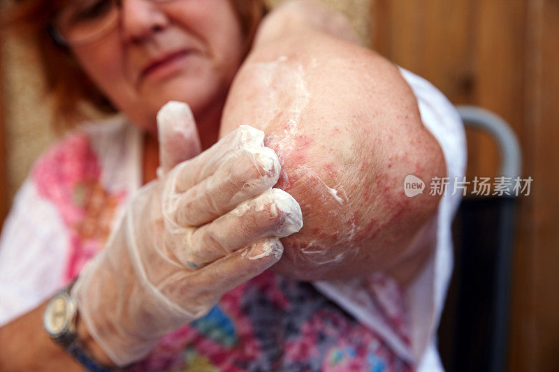 成熟的女人在肘部湿疹上涂霜