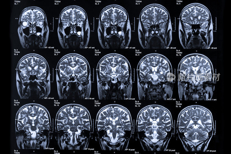 几张不同的磁共振扫描人脑的图像