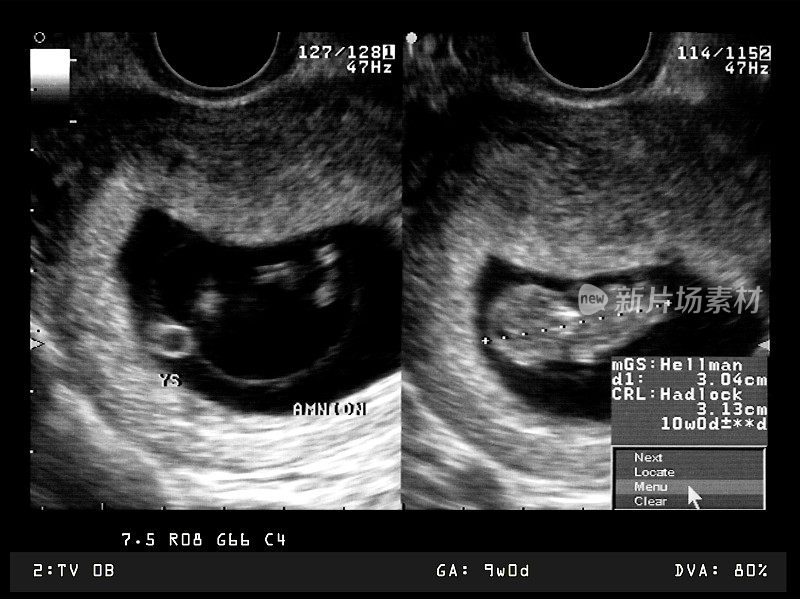 9周龄胚胎的超声检查