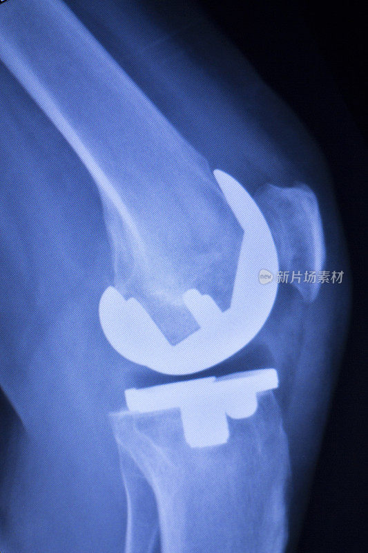 膝关节骨科植入物x线扫描