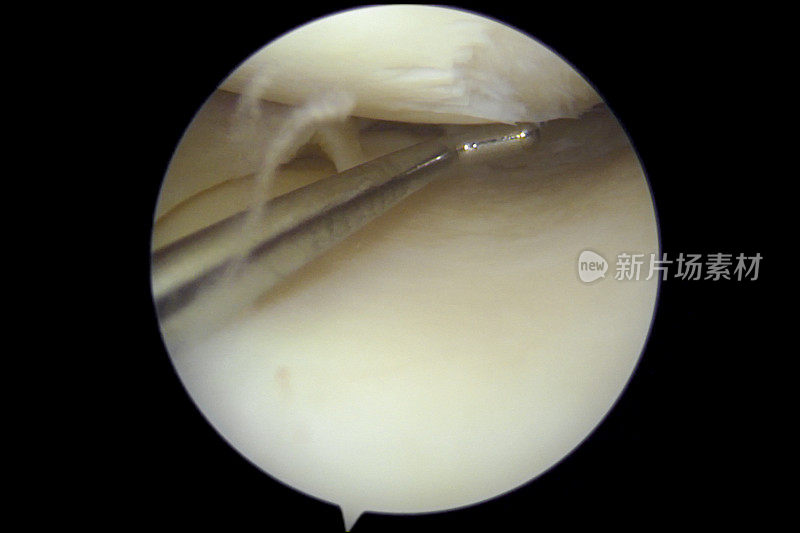 膝关节镜检查显示半月板撕裂和关节软骨缺损