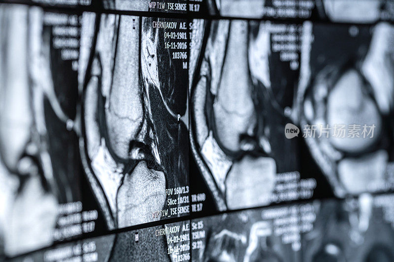 膝关节磁共振(MRI)扫描