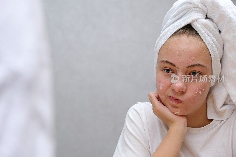 痤疮治疗。一个十几岁的女孩扭曲了她的脸，她不喜欢，因为痤疮。