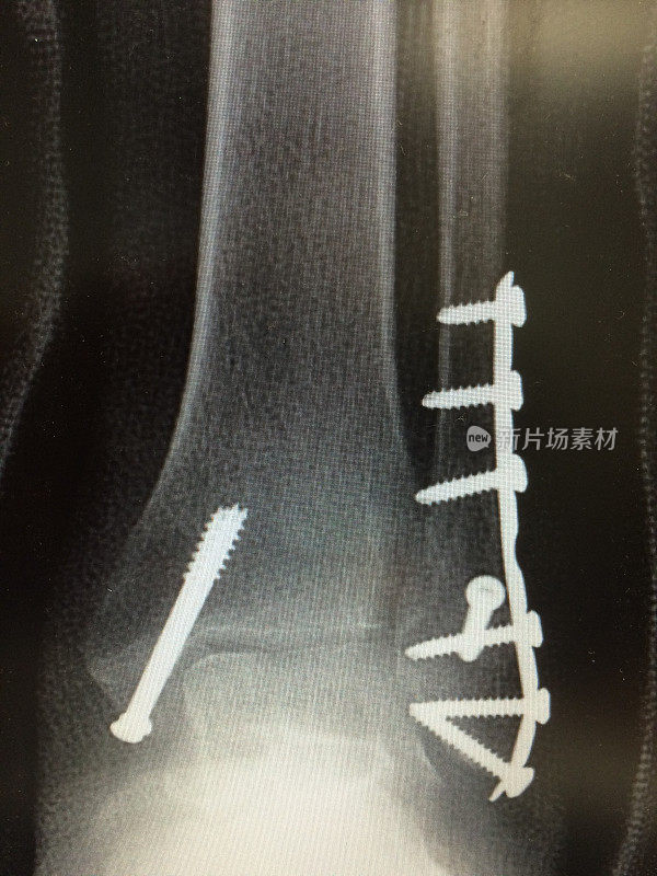 手术固定后踝关节骨折的x线照片