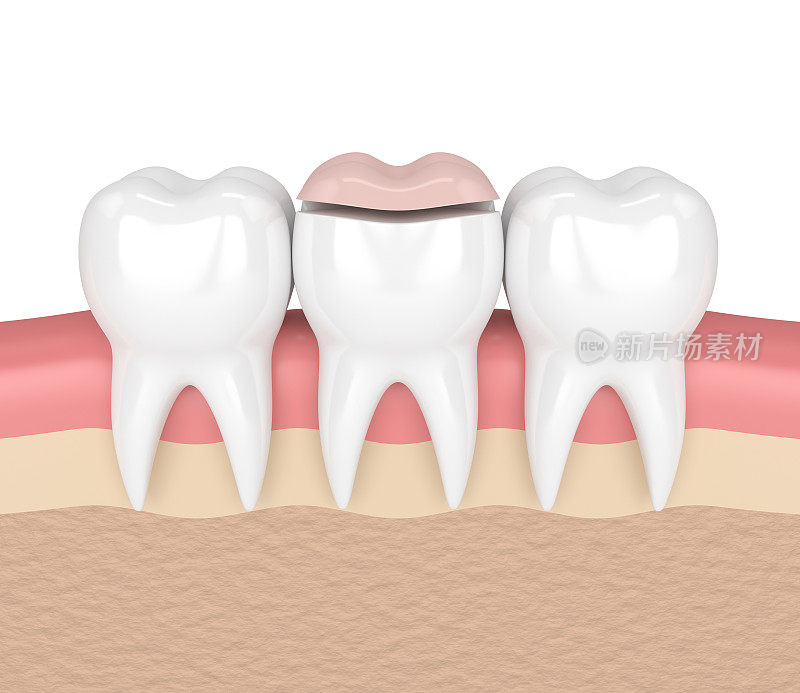 牙齿的3d渲染与牙齿高嵌填充
