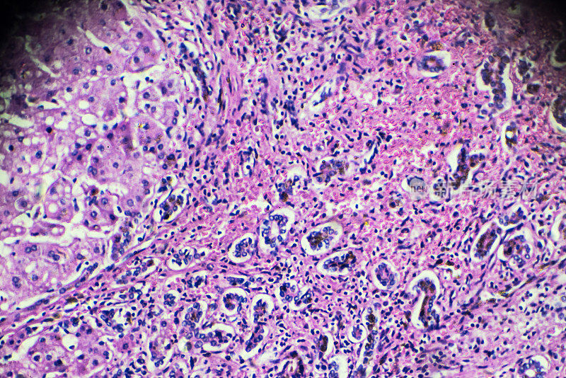 胆汁性肝硬化。显微镜下的人类病理标本