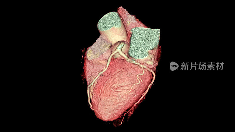 3D心脏，CTA冠状动脉