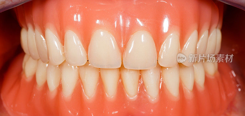 丙烯酸可移动的假牙