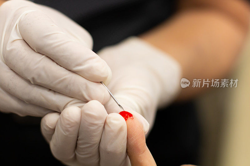 近距离护士在女患者手臂上扎针，抽取血液样本进行艾滋病病毒血液检测