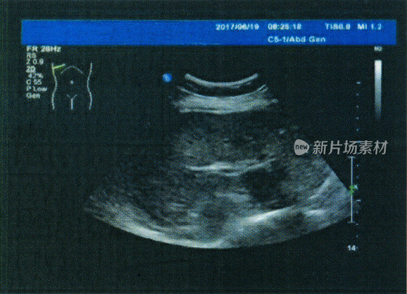 肝、胆、胰、脾、肾、肾上腺彩色多普勒超声医学检查图像