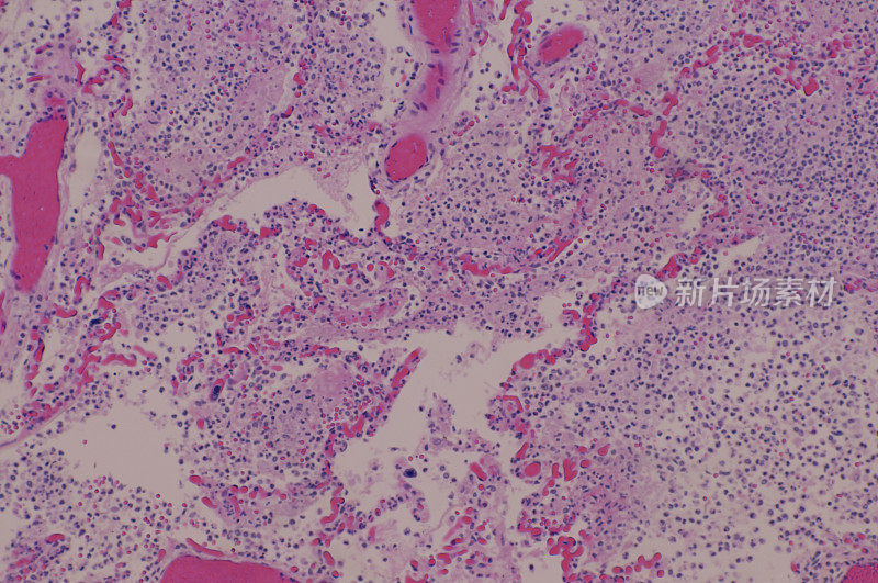 肺炎患者肺组织的显微照片