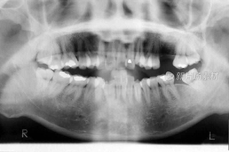 成人牙齿和牙龈x光片