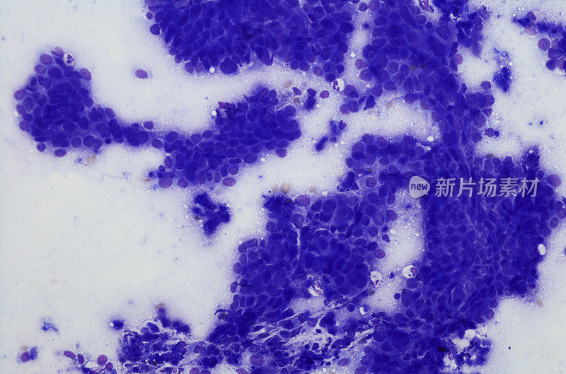 食管癌细胞学检查。Diff-quik污点