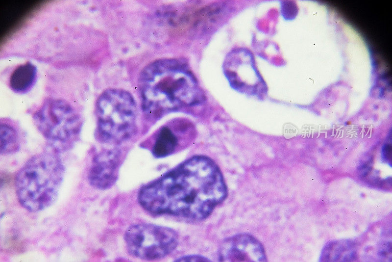 肝细胞癌，显微镜下的HCC
