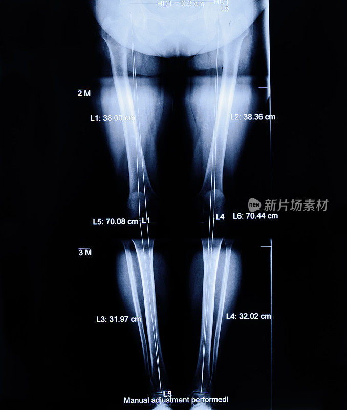 腿x射线