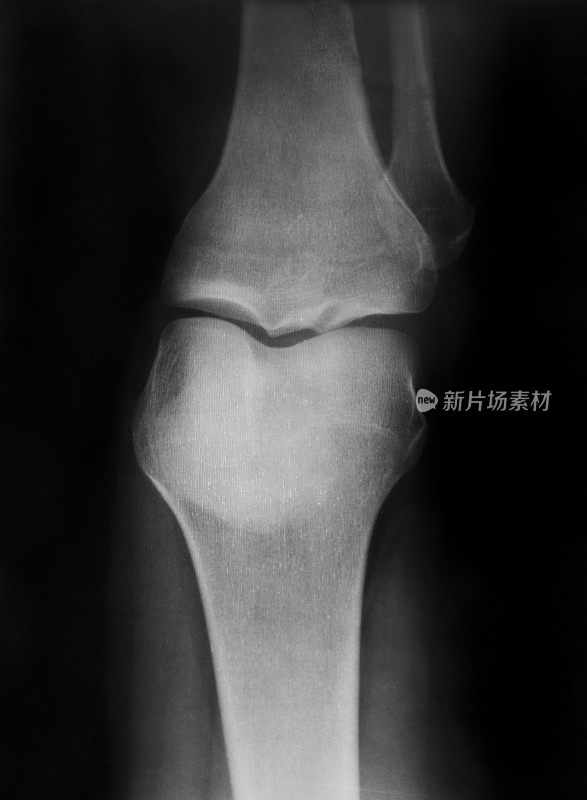 膝盖x射线