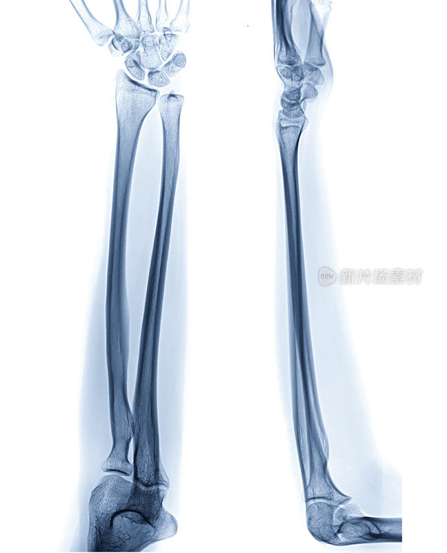 左前臂的x线片或x线片显示正常的前臂正位和侧位。