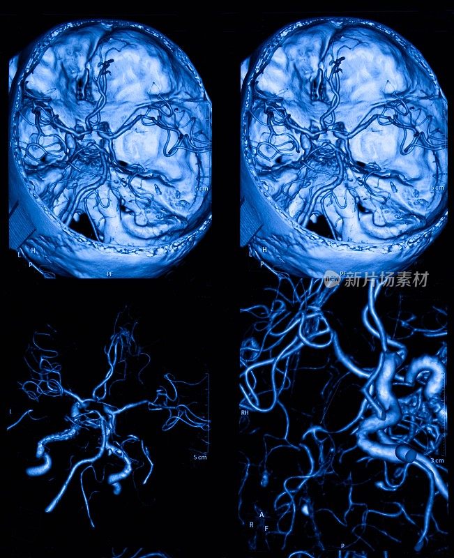 MRI扫描人脑和大脑动脉断层扫描
