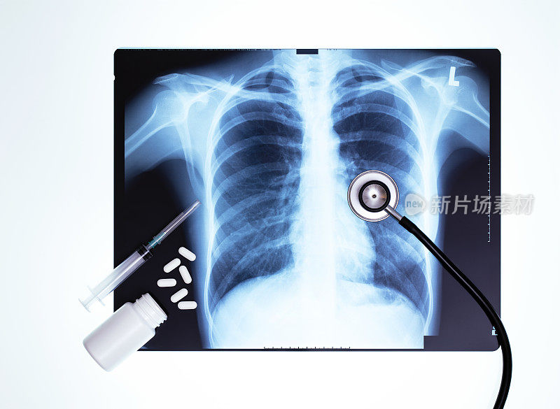 用于人体胸部x光检查的医疗设备