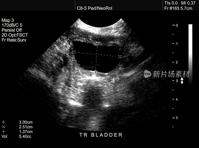 新生儿膀胱超声扫描