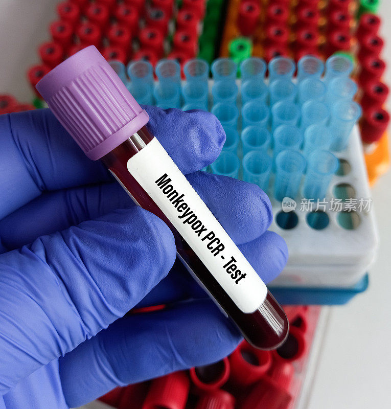 猴痘病毒PCR检测血样管。这是一种双链DNA人畜共患病病毒