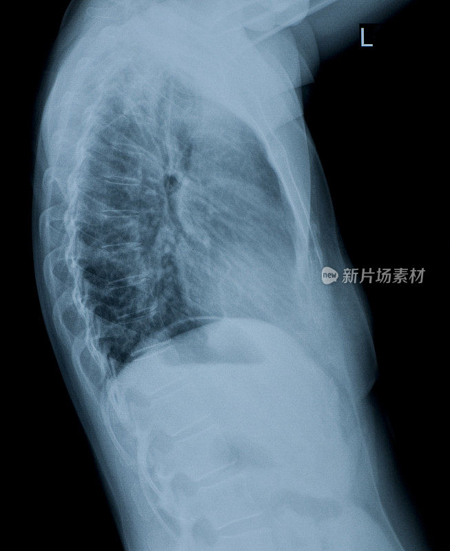 肺x线影像
