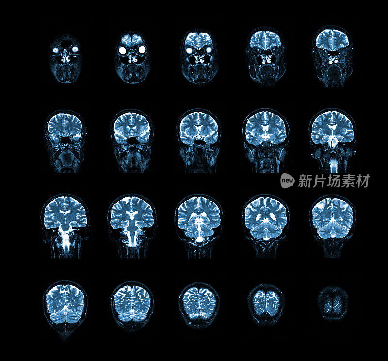 核磁共振扫描人脑