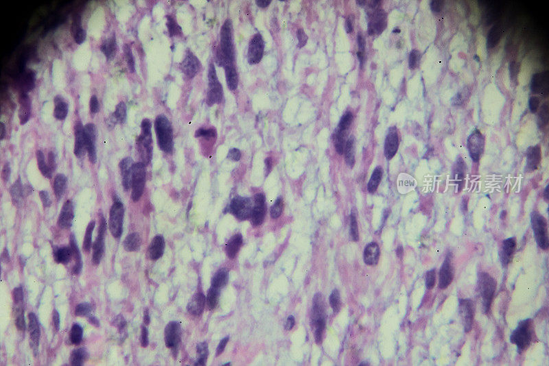 显微镜下横纹肌肉瘤活检