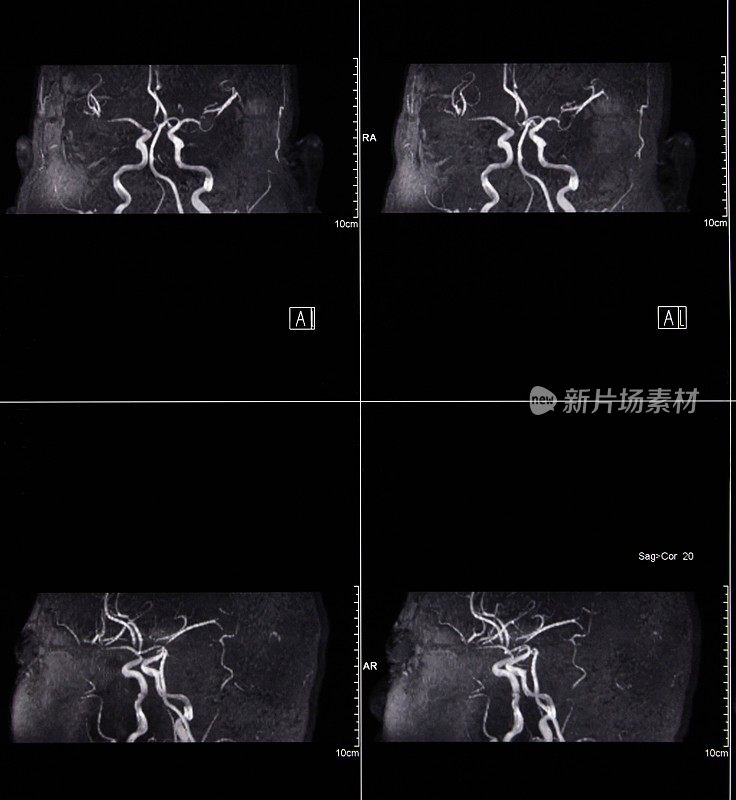 MRI扫描人脑和大脑动脉断层扫描