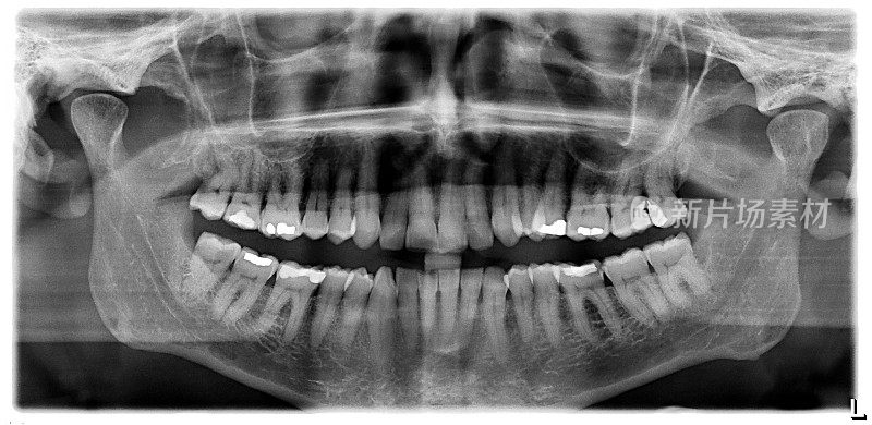 牙齿x射线正面图
