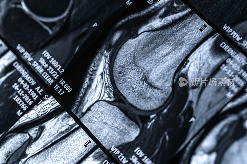 膝关节磁共振(MRI)扫描